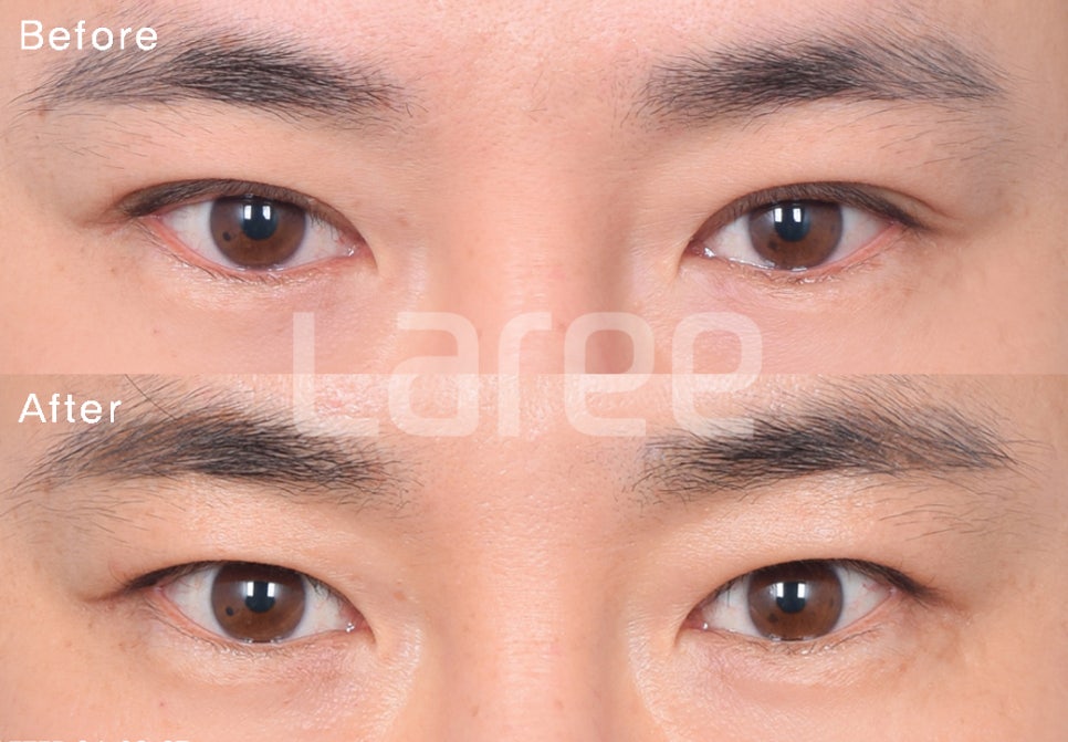 [Lari Plastic Surgery] Everything About Double Eyelid Removal Surgery image 1