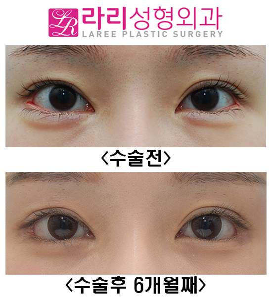 [Rari Plastic Surgery] Canthoplasty Revision Surgery, Entropion Surgery, Under-Eye Fat Repositioning Before-and-After Photos image 1
