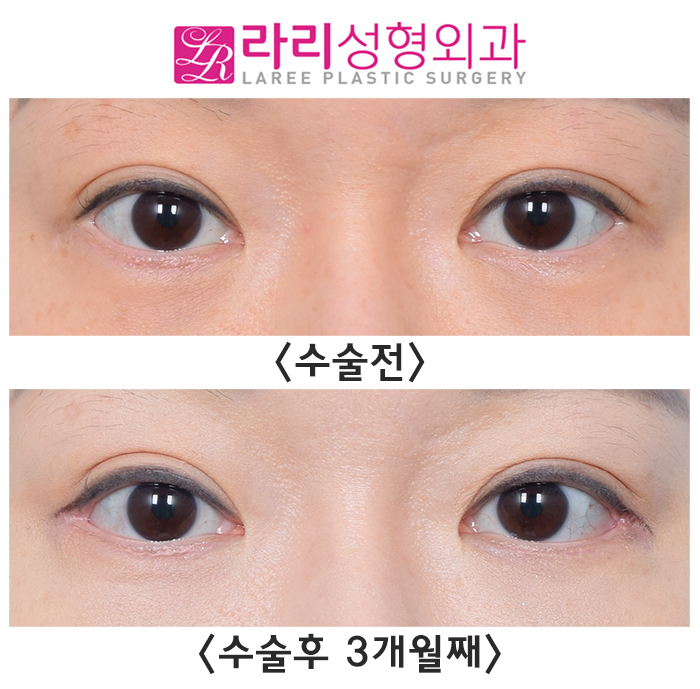 [Rari Plastic Surgery] Rari Plastic Surgery, a clinic that does revision lateral canthoplasty clearly and well image 1