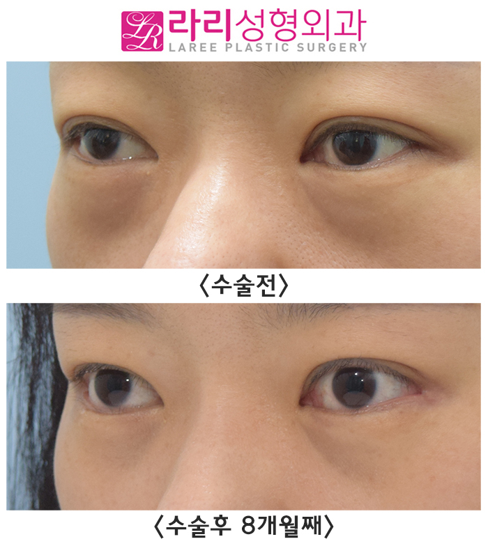 [라리성형외과] 뒤트임수술과 눈밑지방재배치 함께 하면 좋은 수술 best 관련 이미지 2