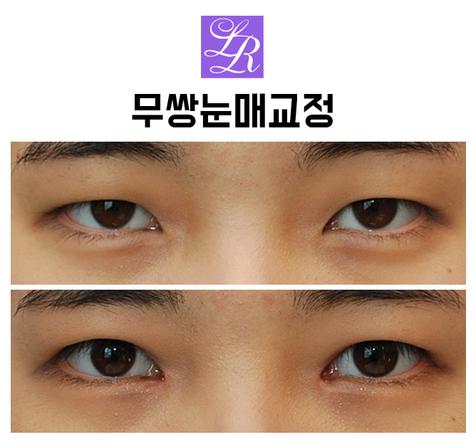 자연스러운 안검하수 교정  -무쌍눈매교정, 비절개눈매교정 관련 이미지 1
