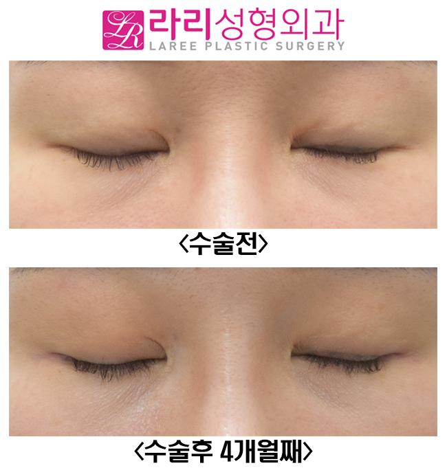 [라리성형외과] 밑트임복원, 뒤트임재수술 전후 사진 관련 이미지 2
