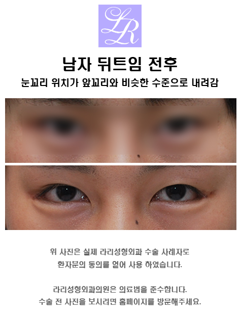 Male Epicanthoplasty - Can It Be Done Together with Canthoplasty? image 5