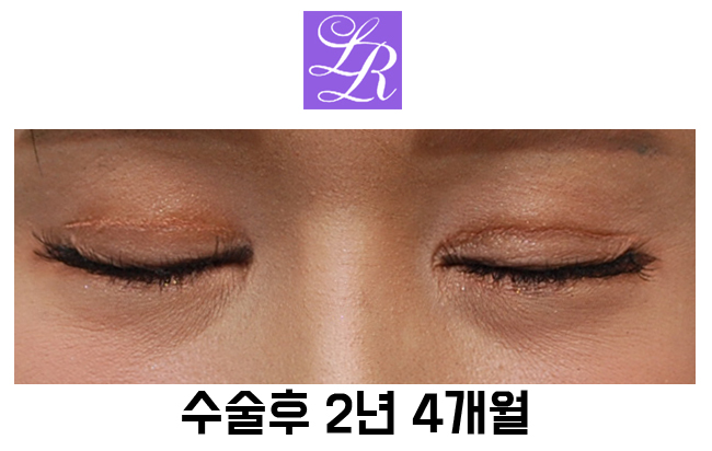 Postoperative Adhesion After Lateral Canthoplasty - The Effect of Revision Lateral Canthoplasty to Lower the Outer Eye Corner image 4