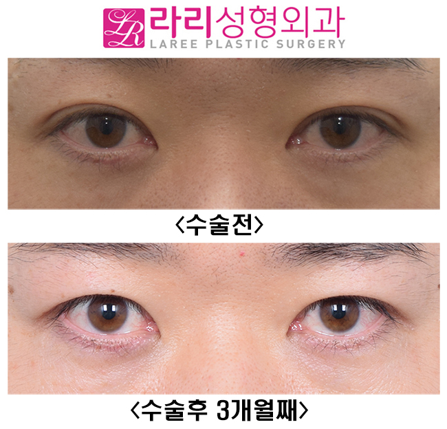 [Lari Plastic Surgery] Lowering the Line of Thick Natural Double Eyelids to a Deep-Eye Style That Looks Like No Double Eyelids image 1