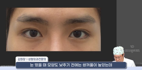[라리성형외과] 쌍꺼풀재수술 라인 낮추는 두 가지 수술법 (절제방법 , 두줄따기방법) 관련 이미지 8