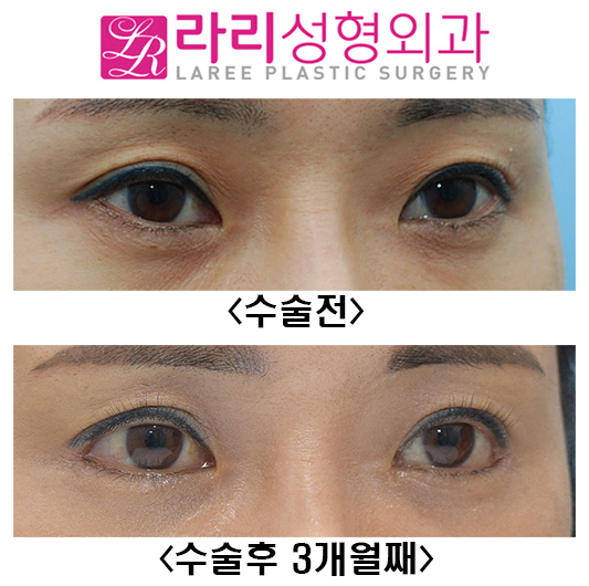 [Lari Plastic Surgery] Before-and-After Photos 3 Months After First Canthoplasty image 2