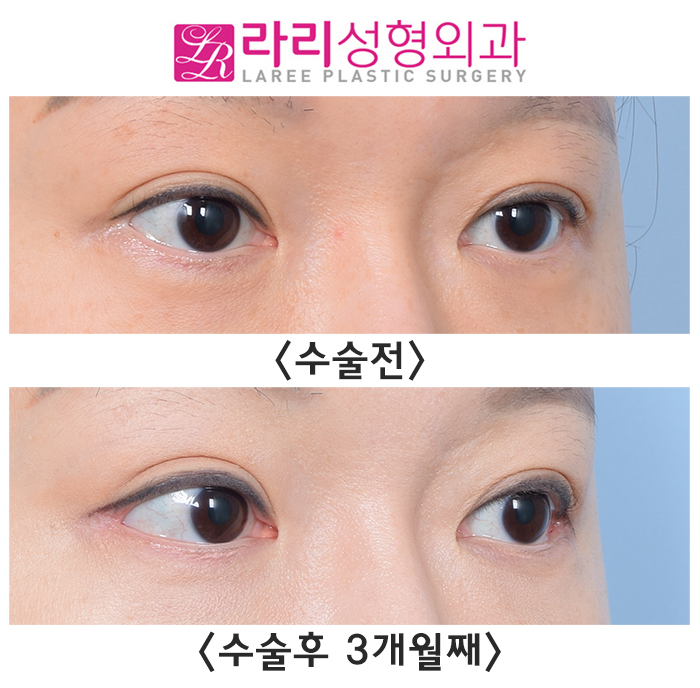 [Rari Plastic Surgery] Rari Plastic Surgery, a clinic that does revision lateral canthoplasty clearly and well image 2