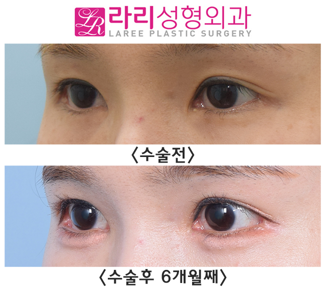 [라리성형외과] 효과 못 본 트임수술, 제대로 터주는 재수술로 유명한 이유가 있습니다. 관련 이미지 2
