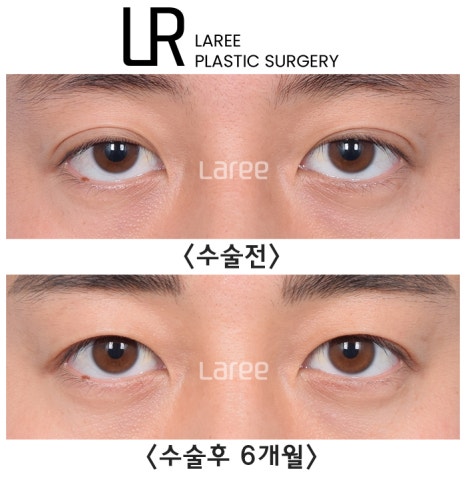 [라리성형외과] 쌍꺼풀없애는 무쌍 수술, 쌍꺼풀라인 낮추기가 아닙니다. (완전무쌍과 무쌍속쌍 그 차이) 관련 이미지 5