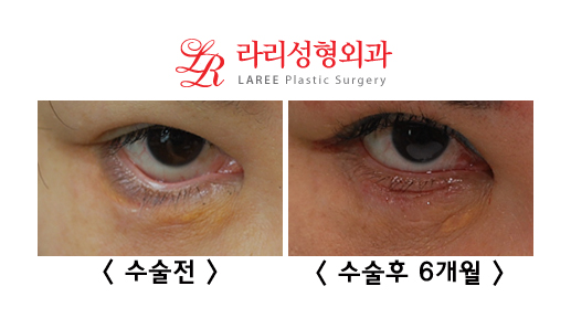 Complications of Lower Blepharoplasty: Ectropion Correction (Senile, Traumatic, Iatrogenic) image 5