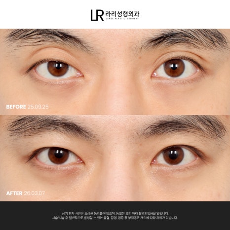 [라리성형외과] 눈 (재) 수술은 라리성형외과가 관련 이미지 15