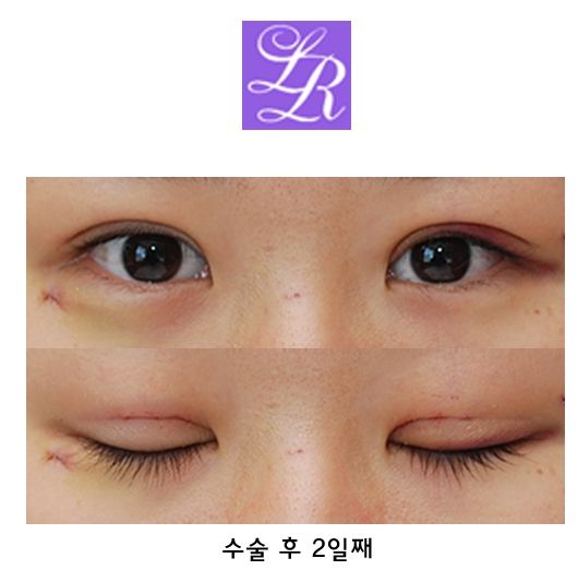 쌍수매몰 사진 후기 - 1주일 회복과정 관련 이미지 3