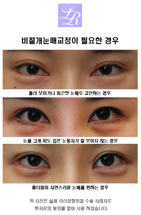 Why Does Non-Incisional Ptosis Correction Come Undone in Monolid Ptosis? image 1