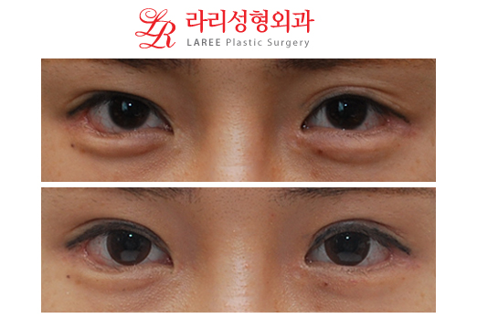 찌그러진 쌍꺼풀과 두꺼워진 삼겹풀 교정(쌍꺼풀풀림) 수술전후 관련 이미지 1