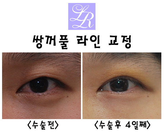 쌍꺼풀재수술 왜 필요한거죠? 라인교정, 붓기, 경과, 흉터교정 관련 이미지 6