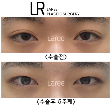 [라리성형외과] 쌍꺼풀수술은 괜찮은데 쌍꺼풀없애는수술은 괜찮지 않다고 ? 관련 이미지 2
