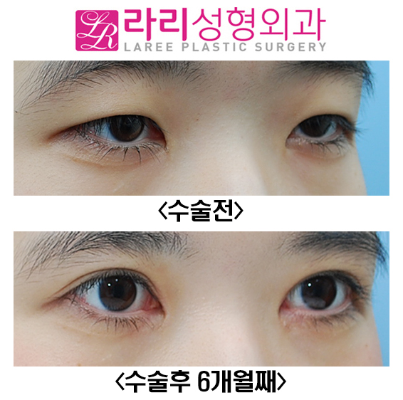 [Lari Plastic Surgery] Before-and-After Photos Showing Clear Results from Incisional Eye Correction and Epicanthoplasty image 2