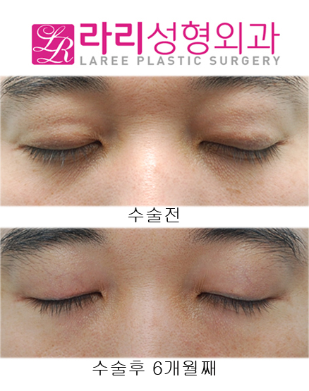 [Lari Plastic Surgery] Removing Double Eyelids After Multiple Buried Double-Eyelid Surgeries image 3