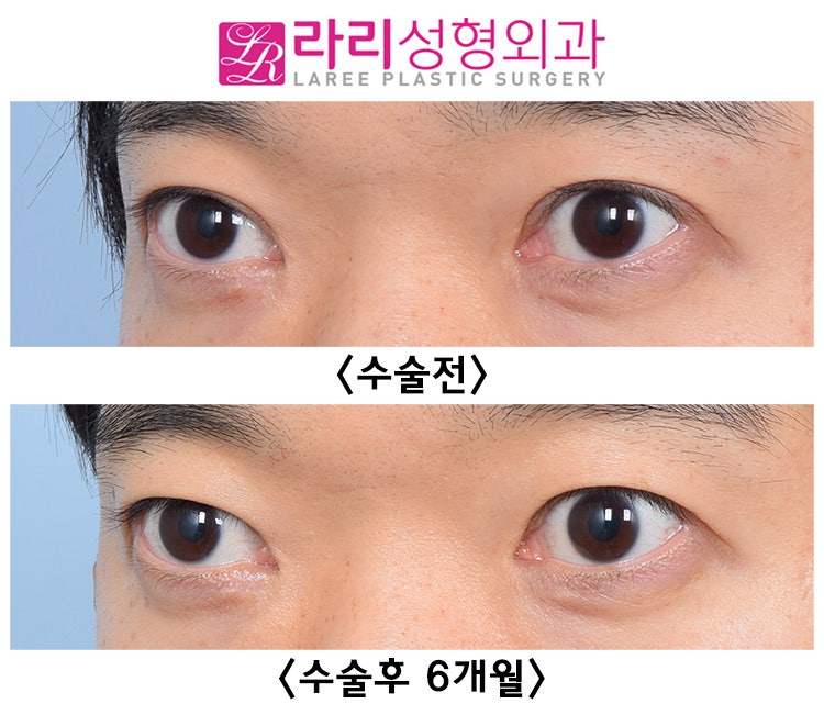 [LARI Plastic Surgery] The Best Time for Double-Eyelid Revision Surgery: Before and After Removing an Incisional Double-Eyelid Line One Year After Surgery image 2