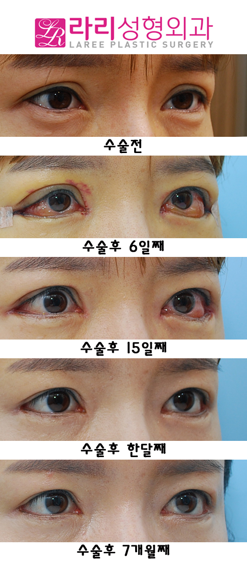 Sausage Correction, Epicanthoplasty, and Revision Surgery for Lateral Canthoplasty with Lowered Outer Eye Corners image 4