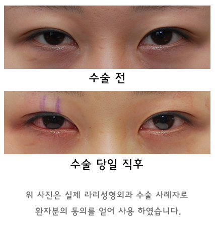 Swelling and Results Judged from Photos in Non-Incision Eye Correction Reviews image 8