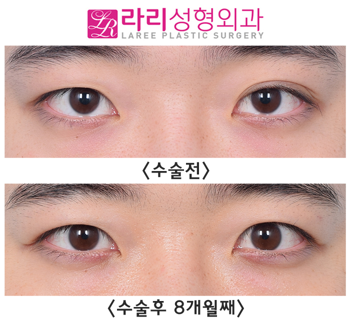 [라리성형외과]  한쪽만 진한 자연쌍꺼풀, 쌍꺼풀없애기 양쪽 다 수술한 전후사진 관련 이미지 3