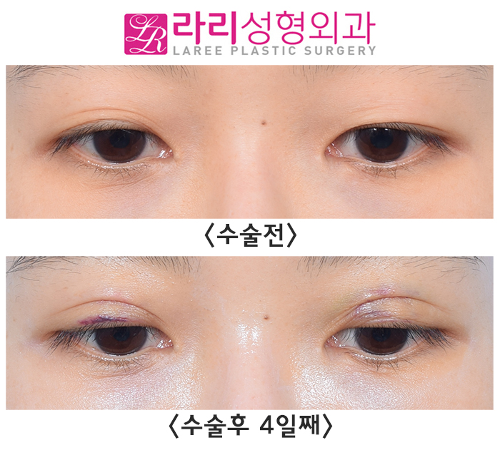 [라리성형외과] 비절개 재수술로 짝짝이 눈 교정하기 관련 이미지 3