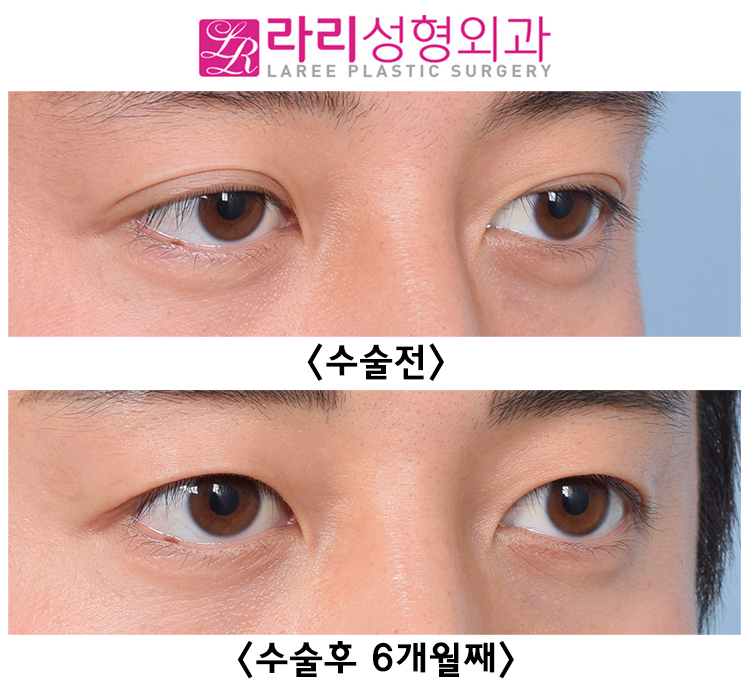 [Rari Plastic Surgery] Double-Eyelid Removal Surgery That Corrects Three-White Eye Without Lower Eyelid Surgery image 1