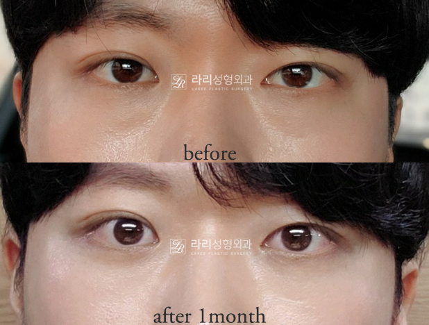[Lari Plastic Surgery] For Bulging Under-Eyes That Eye Bag Creams / Eye Bag Patches Can’t Fix: Lower Eyelid Fat Repositioning! image 5