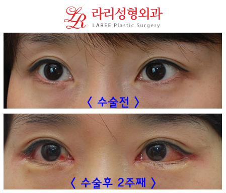 Epicanthoplasty: Is It Worth the Cost? image 5
