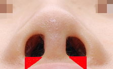 Short Upturned Nose Revision Surgery: Rib Cartilage Is Essential! (feat. Alar Reduction) image 6