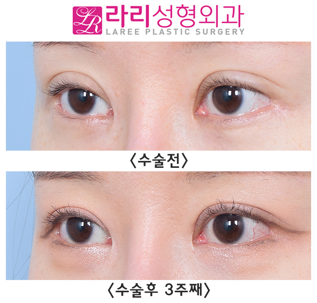 [라리성형외과] 소세지쌍꺼풀 라인 확 낮추는 게 훨씬 예뻐요. 관련 이미지 3