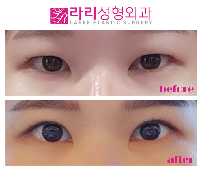 [Lari Plastic Surgery] Incisional Eye Correction Surgery for a Hidden Double Eyelid in a Monolid: Swelling Period Before and After (+Selfie) image 1