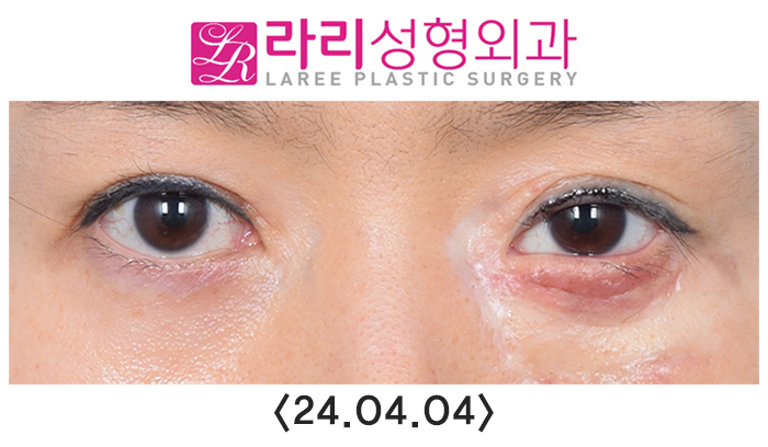 [라리성형외과] 연골이식으로 하안검외반의 일종인 삼백안 교정하기 관련 이미지 6