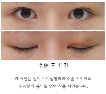 Swelling and Results Judged from Photos in Non-Incision Eye Correction Reviews image 6