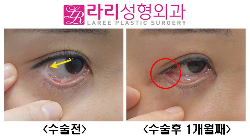 [라리성형외과] 뒤트임재수술,결막이식으로 뒤트임부작용(물갈퀴변형, web deformity) 교정하기 관련 이미지 4