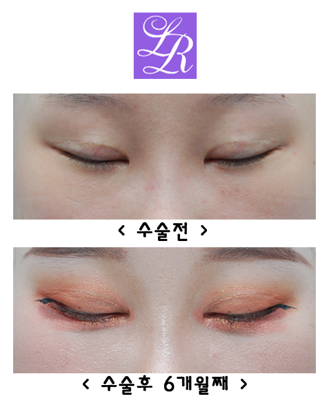 How Can You Correct Eyes With a Fierce Impression and Upturned Outer Corners? image 2