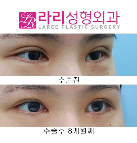 [라리성형외과] 쌍꺼풀재수술 소세지교정, 뒤트임재수술 관련 이미지 3