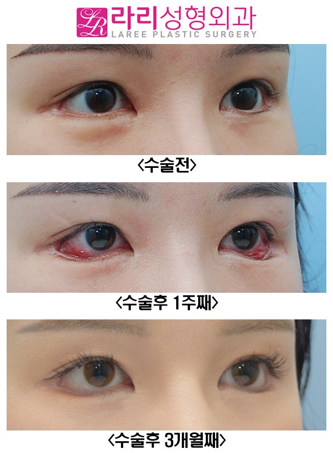 [Lari Plastic Surgery] Revision Lower Blepharoplasty: From Pre- and Post-Op Photos to the Recovery Course with Swelling image 2