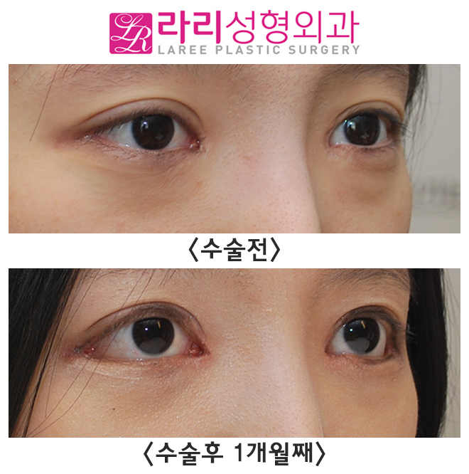 [라리성형외과] 앞트임재수술, 뒤트임재수술, 눈밑지방재배치 수술 한달경과 전후사진 관련 이미지 2