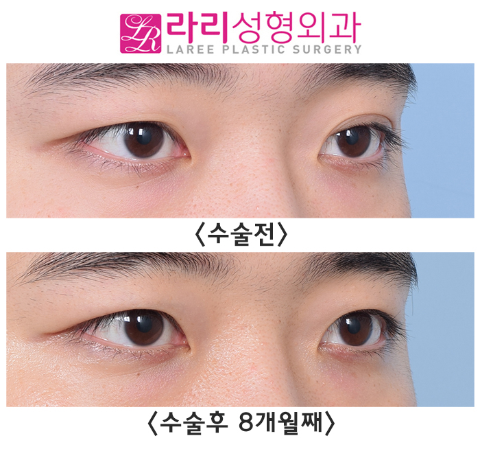 [라리성형외과]  한쪽만 진한 자연쌍꺼풀, 쌍꺼풀없애기 양쪽 다 수술한 전후사진 관련 이미지 4