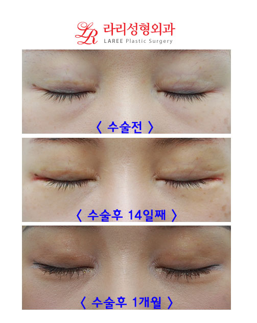 뒷트임재수술, 눈밑지방재배치 콜라보 관련 이미지 2