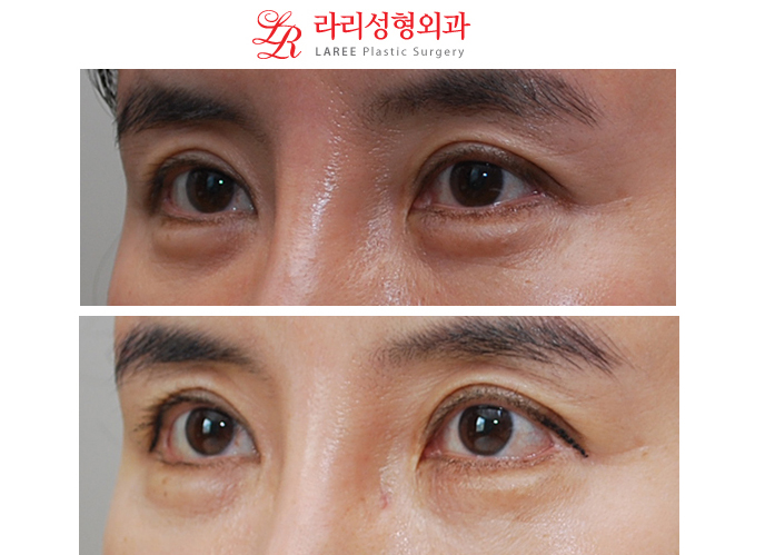 꽃중년 바비밑트임 수술전후사진 관련 이미지 2