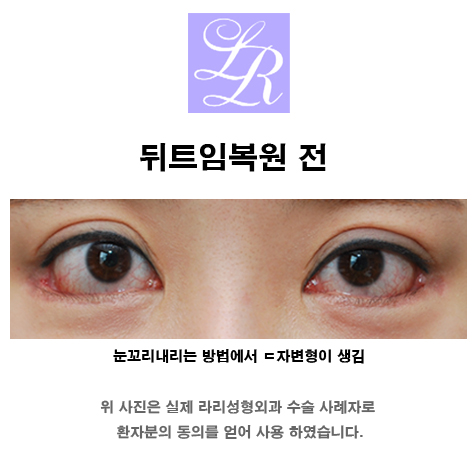 눈 뒤트임복원 (feat. 재건시기, 비용스포)고려하고 있다면 꼭 확인해야 할 포스팅! 관련 이미지 5