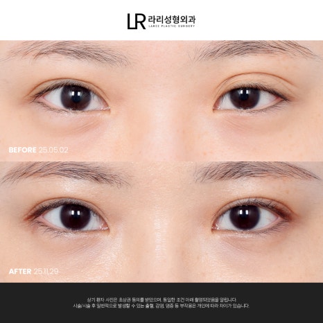 [라리성형외과] 눈 (재) 수술은 라리성형외과가 관련 이미지 12
