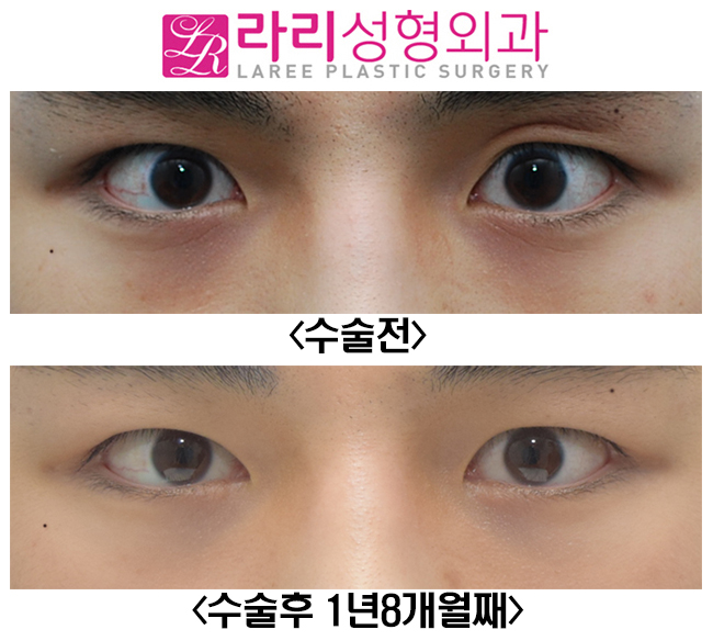 [라리성형외과] 쌍꺼풀없애기와 앞트임수술 전후사진 관련 이미지 4