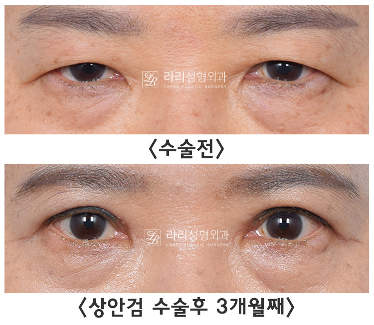 [라리성형외과] 눈꺼풀 처짐 개선하는 상안검수술, 무쌍상안검성형도 가능 관련 이미지 2