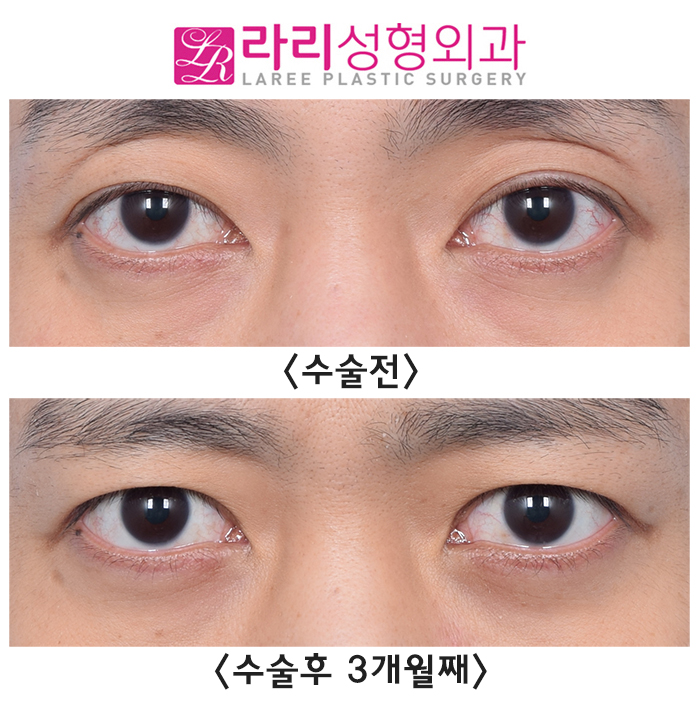 [Lari Plastic Surgery] Bulging Eyes? Sunken Eyes? Smoother with Fat Grafting and Double Eyelid Removal image 2