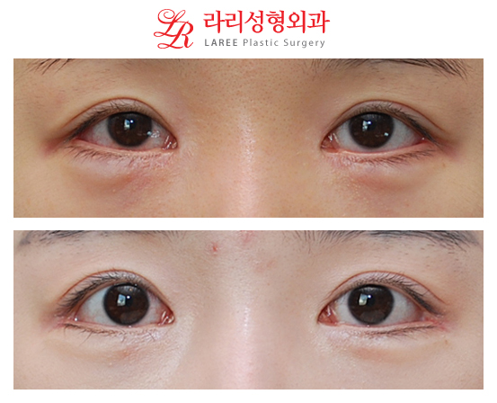 Non-incisional Eye Correction, Lateral Canthoplasty for Lowering the Outer Corners of the Eyes / Before-and-After Photos of Lowering the Outer Corners of the Eyes image 1